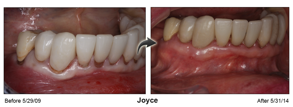 pinhole gum rejuvenation San Jose