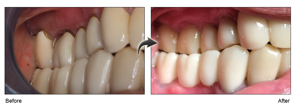 gum recession treatment milpitas