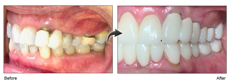 gum recession treatment milpitas