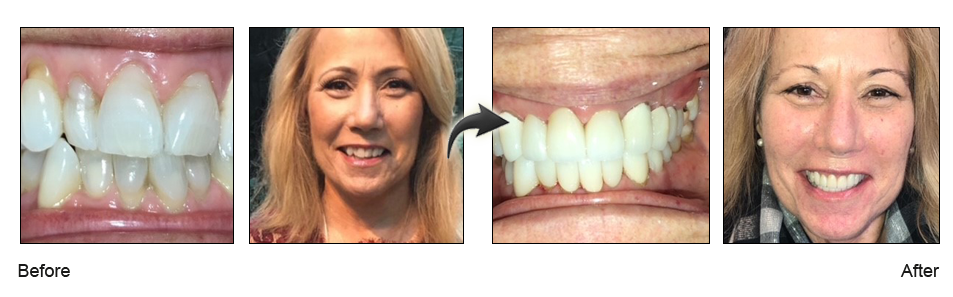 San Jose lunchtime gumlift dentist